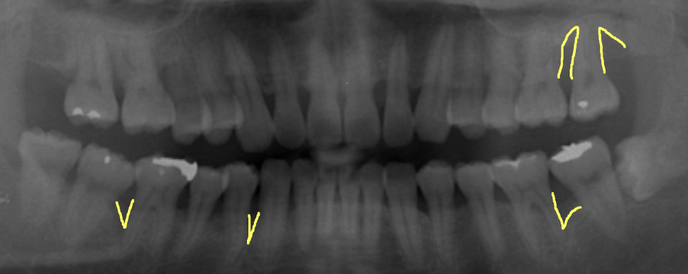 侵襲性歯周炎のレントゲン写真