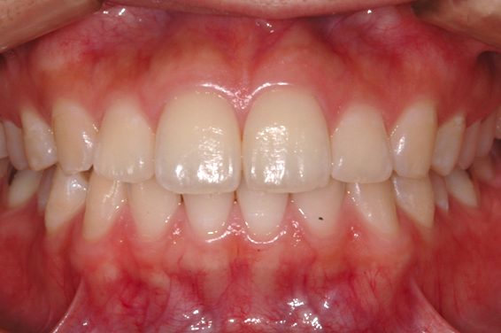 健康な歯ぐき - 歯周病の症状