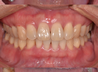 侵襲性歯周炎の治療写真