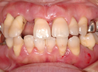 重度歯周病の治療の写真