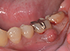 歯内療法の治療写真