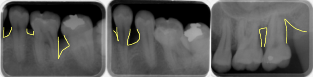 歯槽骨の吸収の様子