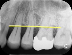 歯槽骨の吸収