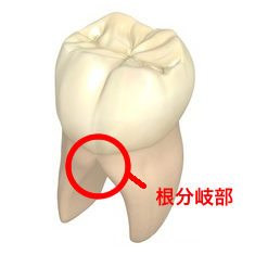 根分岐部病変