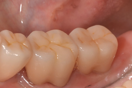 根分岐部病変を歯周組織再生療法で治療後