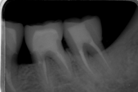 根分岐部病変の歯周組織再生療法