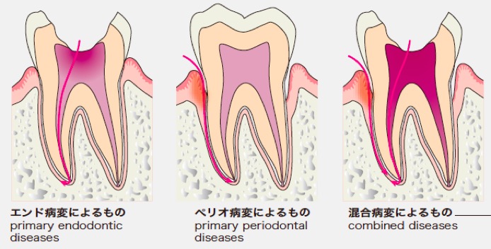 歯肉腫脹の原因