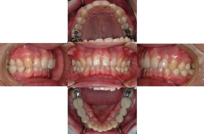 初診時の口腔内写真