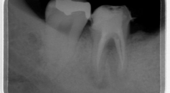 歯内療法後のレントゲン写真