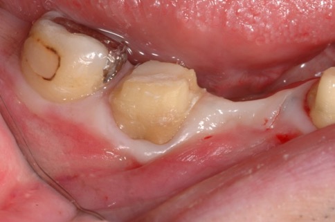 歯内療法後の口腔内写真