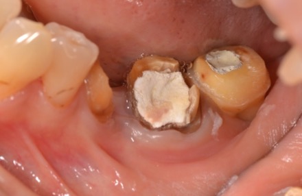 歯内療法（症例３）